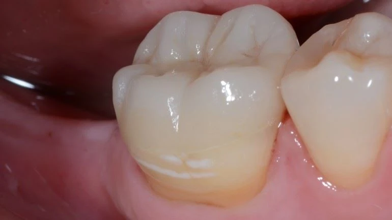 Phương pháp tạo hình gốm Zirconia
